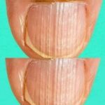 Having Striped Nails Could Mean That Your Body Is, You Have To Know What It Is