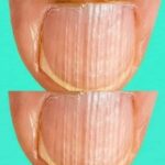 Rippled fingernails reveal secrets of possible disease