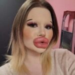 24-year-old Bulgarian woman wants to have the biggest lips in the world